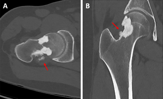 Melorheostosis Involving the Hip Joint.
