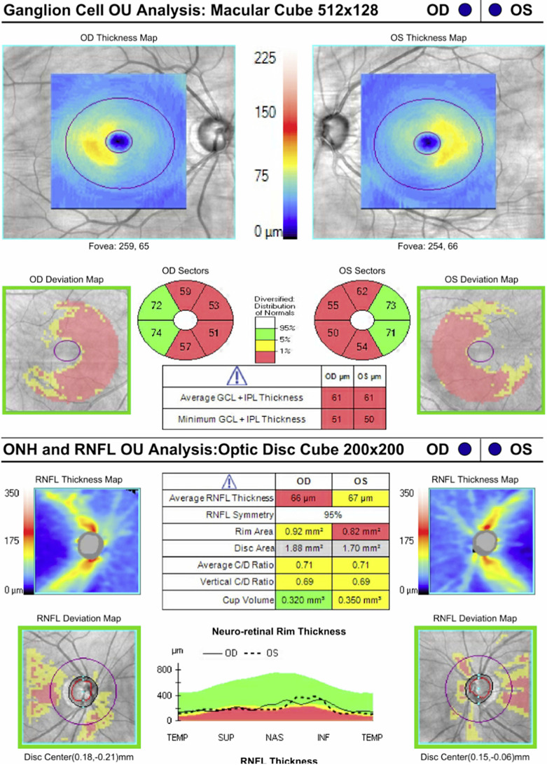 Optical Coherence Tomography Abnormalities as the Presenting Sign of an Involuted Sellar/Suprasellar Mass.