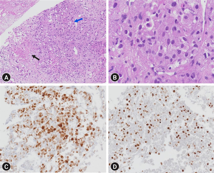 Ruptured triple hormone-secreting adrenal cortical carcinoma with hyperaldosteronism, hypercortisolism, and elevated normetanephrine: a case report.