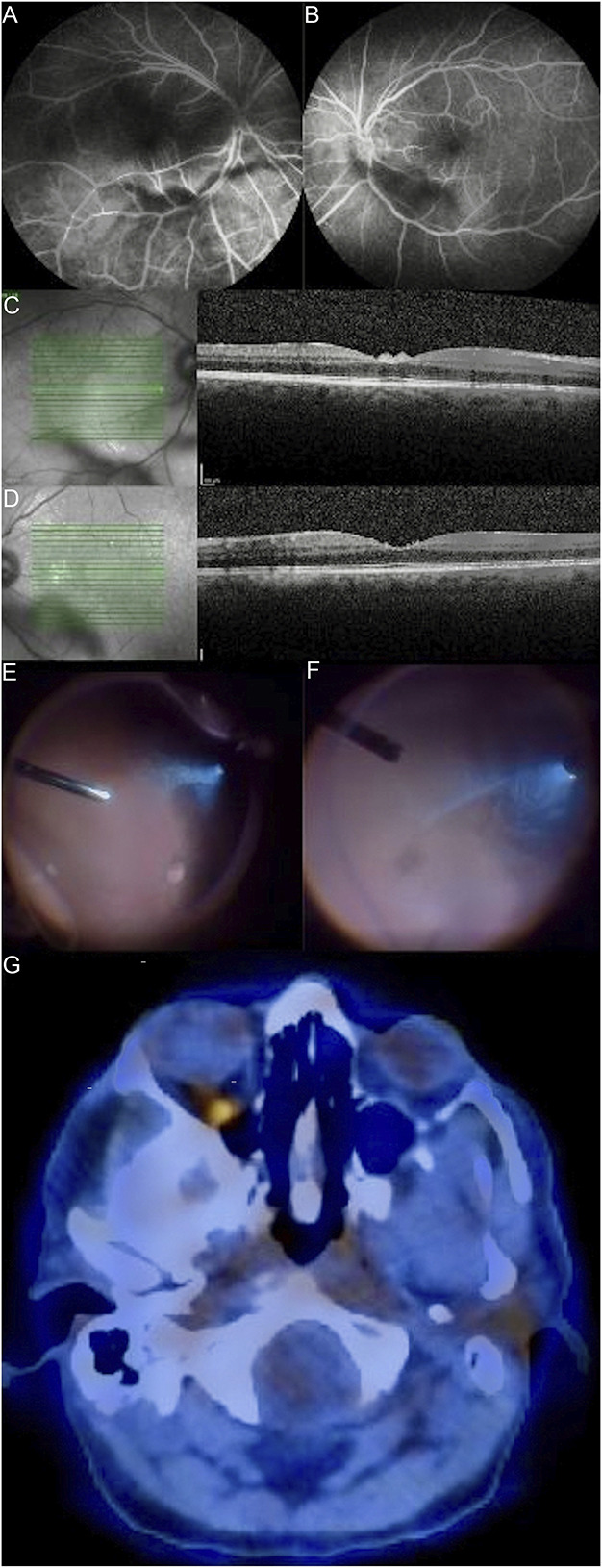Primary vitreoretinal lymphoma masquerading as refractory uveitis-just go with the flow.