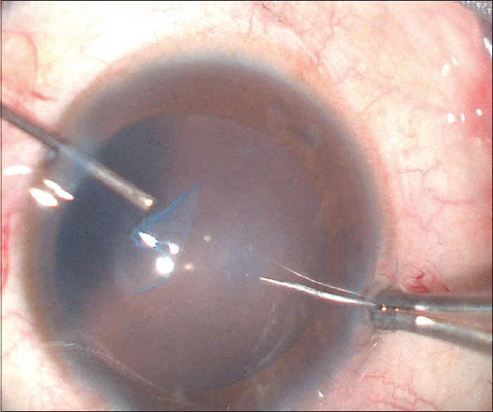 Epicapsular membrane - A surgical surprise.