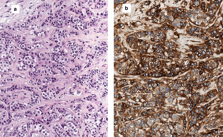 Human Leukocyte Antigen Class I Expression and Natural Killer Cell Infiltration and Its Correlation with Prognostic Features in Luminal Breast Cancers.