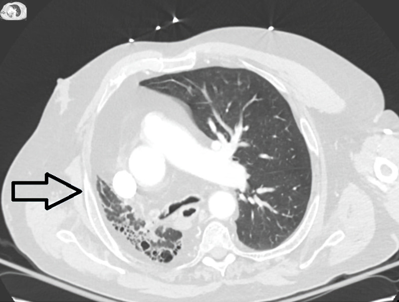 Navigating a Complex Case of Hypoplastic Right Lung With Bronchiectasis: A Ten-Year Journey.