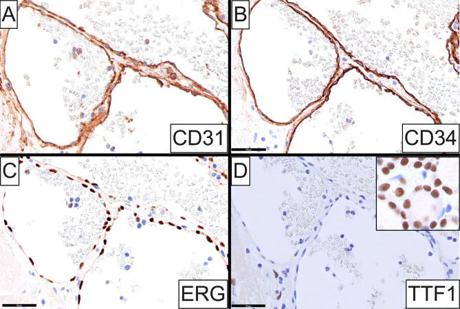 On Vascular Lesions of the Thyroid Gland with Emphasis on Intrathyroidal Hemangioma: Clinicopathologic Characterization of Two Cases and Review of the Literature.