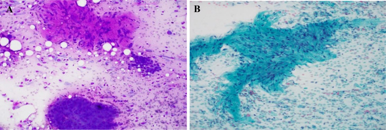 Papillary Thyroid Carcinoma with Fibromatosis/Fasciitis-Like/Desmoid-Type Stroma: Case Report of a Rare Subtype with Cytological and Molecular Study.