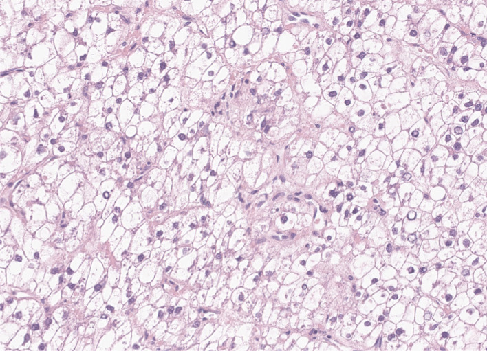 The histopathological and molecular heterogeneity of hepatocellular carcinoma: a narrative review.