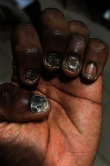 Epidemiologic, Clinical and Mycological Profile of Onychomycosis in the Hospital Setting in Benin.