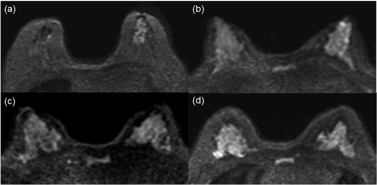 Diagnostic Utility of an Adjusted DWI Lexicon Using Multiple b-values to Evaluate Breast Lesions in Combination with BI-RADS.