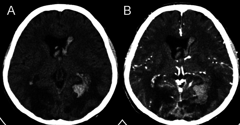 Superior Sagittal Sinus Thrombosis Secondary to Cerebral Aspergillosis with Ventriculitis in an Immunocompetent Patient: A Case Report.