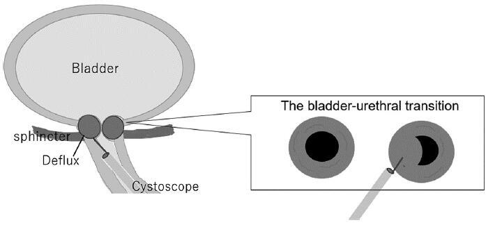 Exploratory trial of urethral submucosa injection therapy of deflux for stress urinary incontinence after radical prostatectomy.