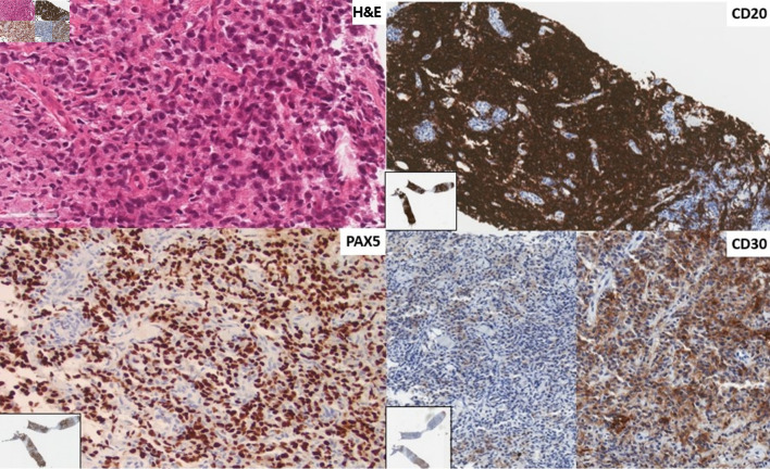 Primary Refractory Discordant Diffuse Large B-Cell and Classical Hodgkin Lymphoma.