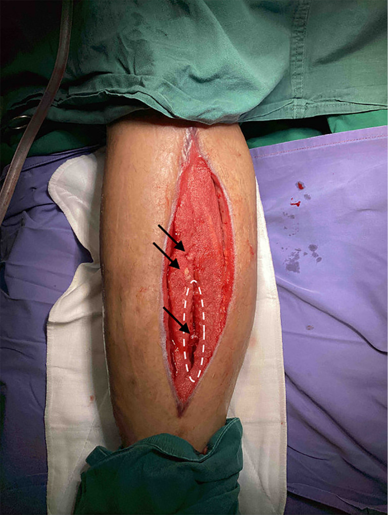 Expedited infection control and wound healing by combining Matriderm<sup>®</sup>, a dermal matrix, and Stimulan<sup>®</sup> absorbable antibiotic beads: a case report.