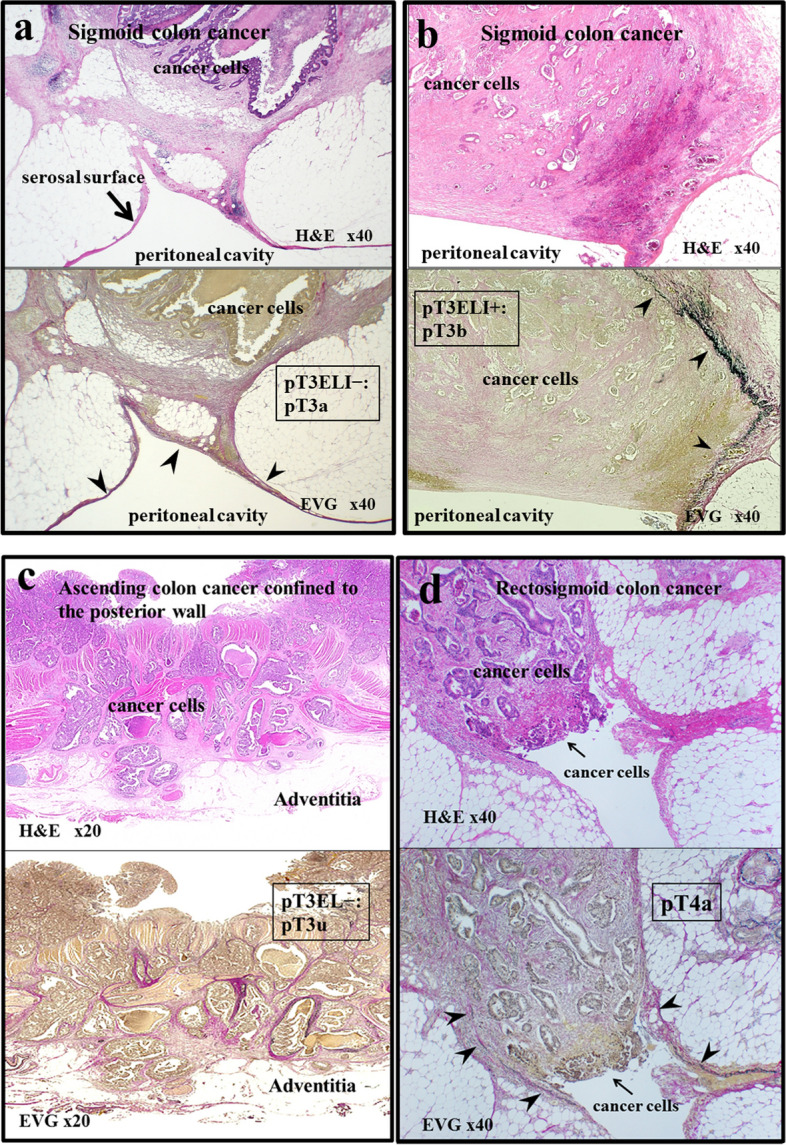 The clinical significance of elastic lamina invasion in patients with pStage II colorectal cancer: a notable prognostic indicator.