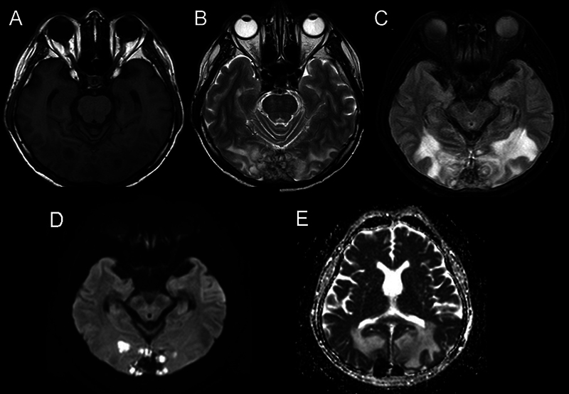 Superior Sagittal Sinus Thrombosis Secondary to Cerebral Aspergillosis with Ventriculitis in an Immunocompetent Patient: A Case Report.