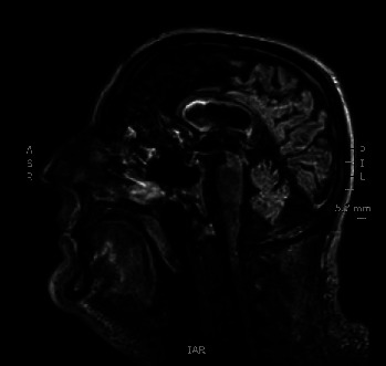 Myxedema Coma as a Presentation of Panhypopituitarism Secondary to Traumatic Brain Injury.