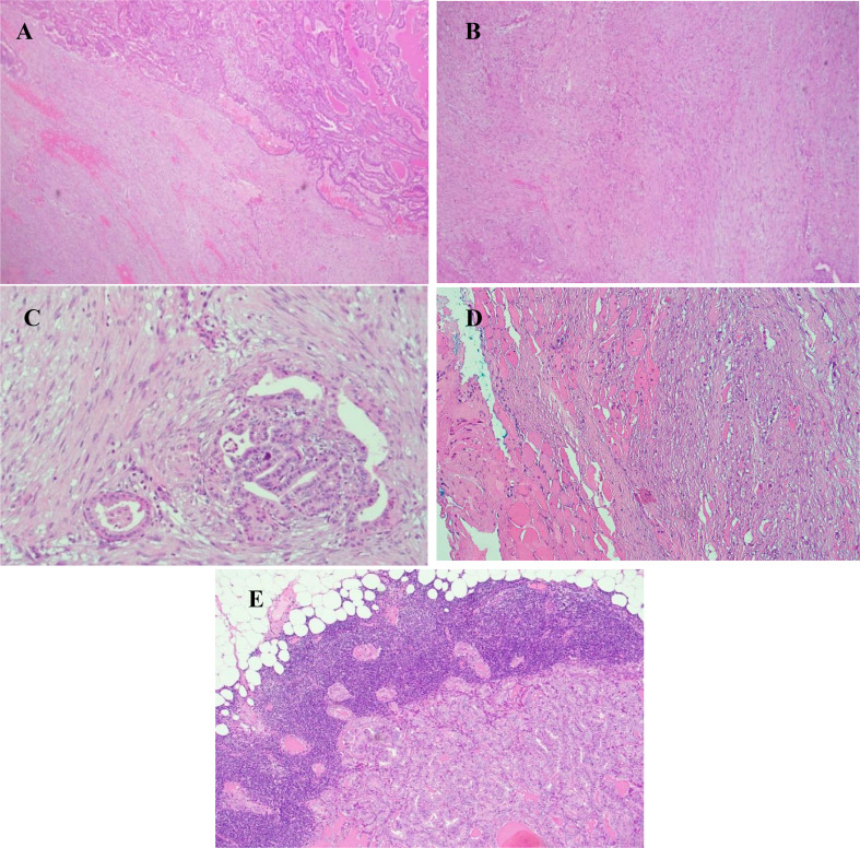 Papillary Thyroid Carcinoma with Fibromatosis/Fasciitis-Like/Desmoid-Type Stroma: Case Report of a Rare Subtype with Cytological and Molecular Study.