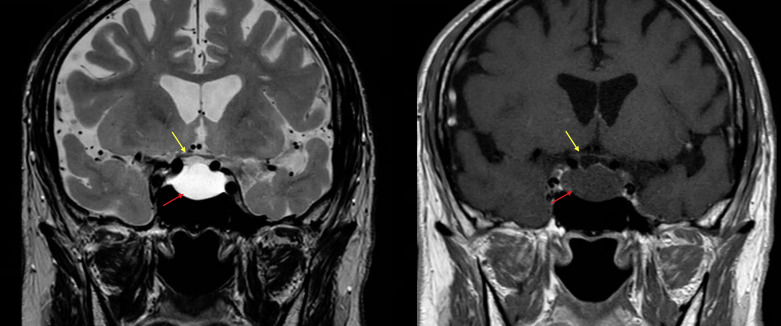 Optical Coherence Tomography Abnormalities as the Presenting Sign of an Involuted Sellar/Suprasellar Mass.