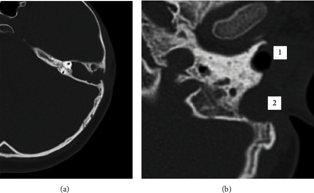 Mastoid Obliteration With Freeze-Dried Bone Allograft in Canal Wall Down Tympanoplasty: Description of a Novel Technique and Case Report.