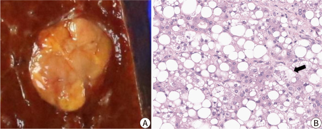The histopathological and molecular heterogeneity of hepatocellular carcinoma: a narrative review.