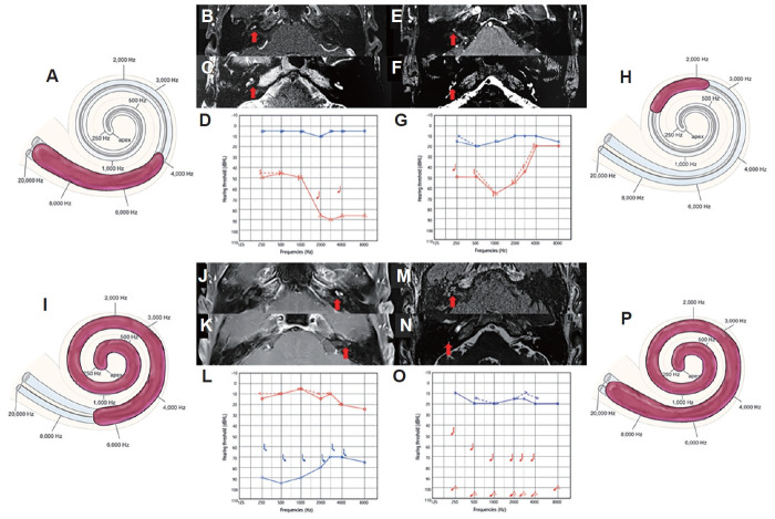 Clinico-Radiological Manifestations of Cochlear Schwannomas.