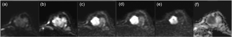 Diagnostic Utility of an Adjusted DWI Lexicon Using Multiple b-values to Evaluate Breast Lesions in Combination with BI-RADS.