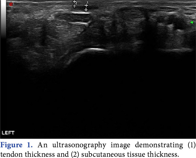 Sensitivity and specificity assessment of four clinical tests for palmaris longus muscle by ultrasound.