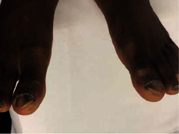 Epidemiologic, Clinical and Mycological Profile of Onychomycosis in the Hospital Setting in Benin.