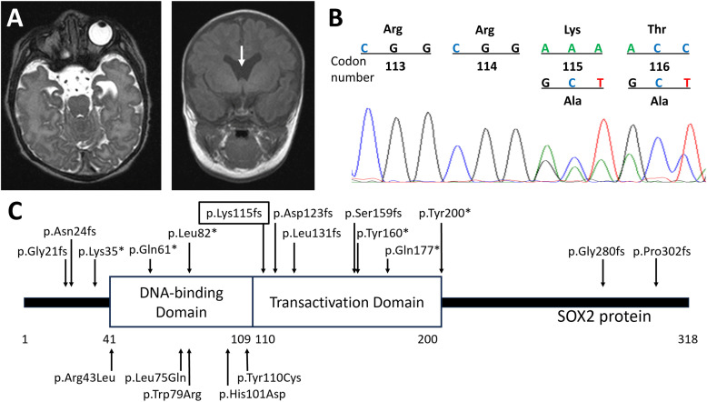 A novel <i>SOX2</i> frameshift pathogenic variant located in the transactivation domain in a male infant with hypogonadotropic hypogonadism.