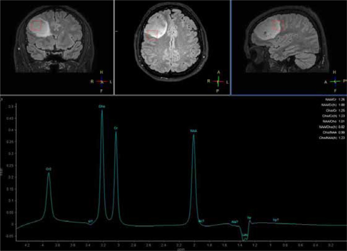The peritumoral brain zone in glioblastoma: a review of the pretreatment approach.