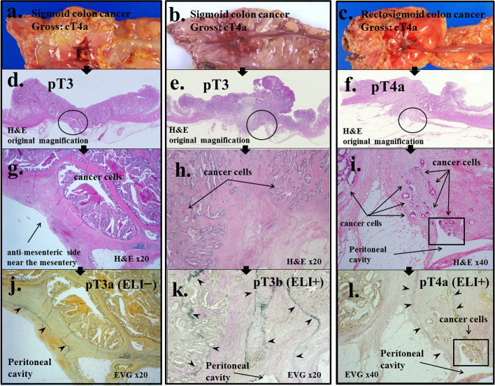 The clinical significance of elastic lamina invasion in patients with pStage II colorectal cancer: a notable prognostic indicator.