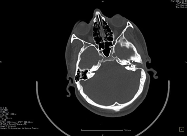 Biology of recurrent cholesteatoma in a Romanian young patient - a case report.