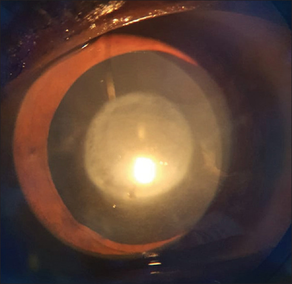 Epicapsular membrane - A surgical surprise.