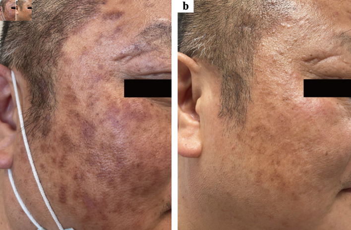 Successful Treatment of Idiopathic Multicentric Castleman Disease With Rash as the Initial Symptom Using a Rituximab-Based Regimen.