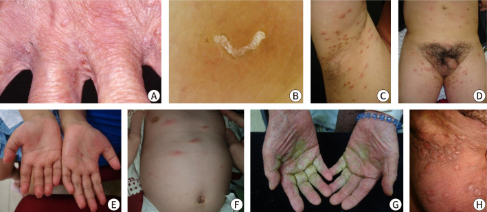 Clinical practice guidelines for the diagnosis and treatment of scabies in Korea: Part 1. Epidemiology, clinical manifestations, and diagnosis - a secondary publication.
