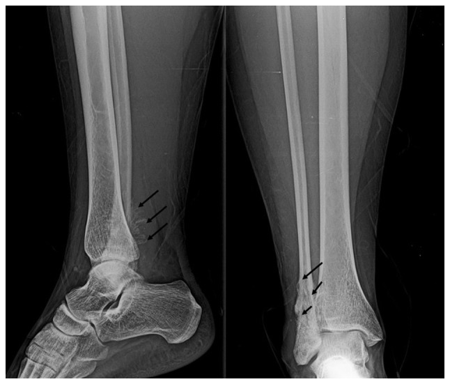 Successful treatment of osteosarcoma in a pregnant woman with survival of the gestational product: A case report and literature review.