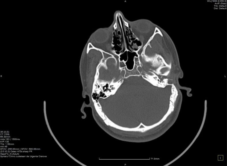 Biology of recurrent cholesteatoma in a Romanian young patient - a case report.
