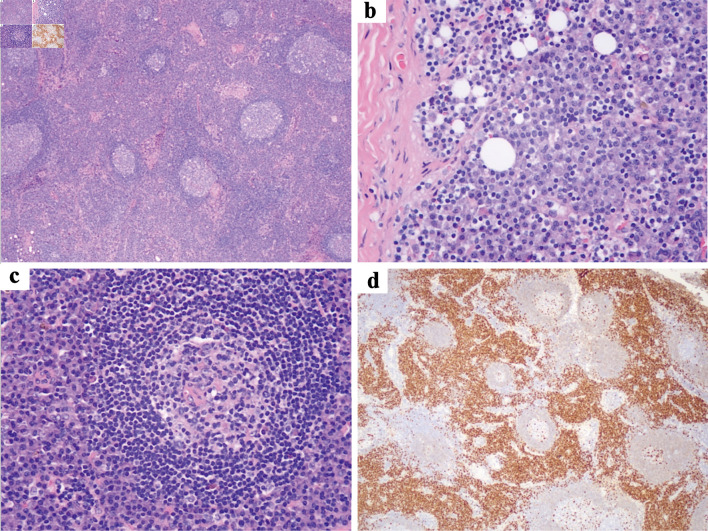 Successful Treatment of Idiopathic Multicentric Castleman Disease With Rash as the Initial Symptom Using a Rituximab-Based Regimen.