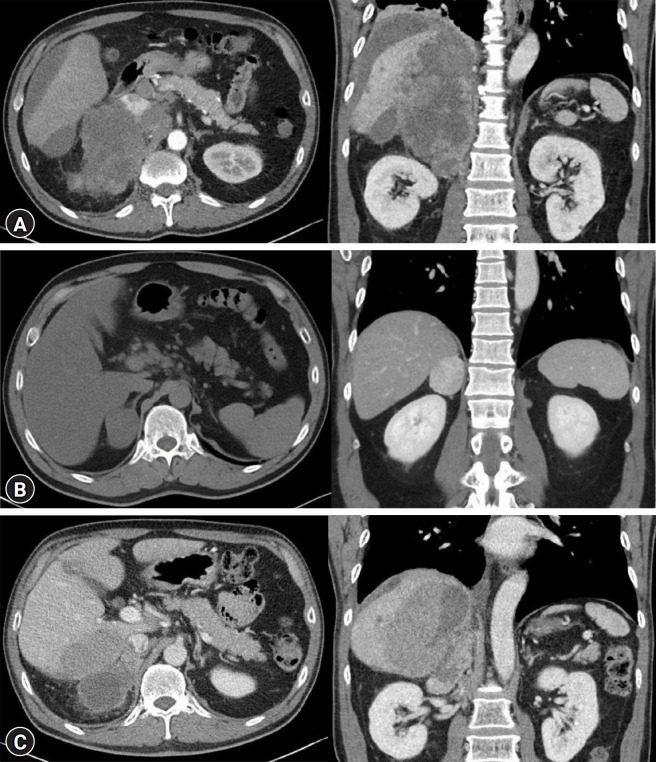 Ruptured triple hormone-secreting adrenal cortical carcinoma with hyperaldosteronism, hypercortisolism, and elevated normetanephrine: a case report.