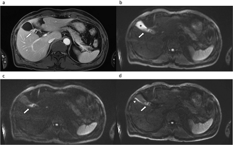 Evaluating Biliary Malignancy with Measured and Calculated Ultra-high b-value Diffusion-weighted MR Imaging at 3T.