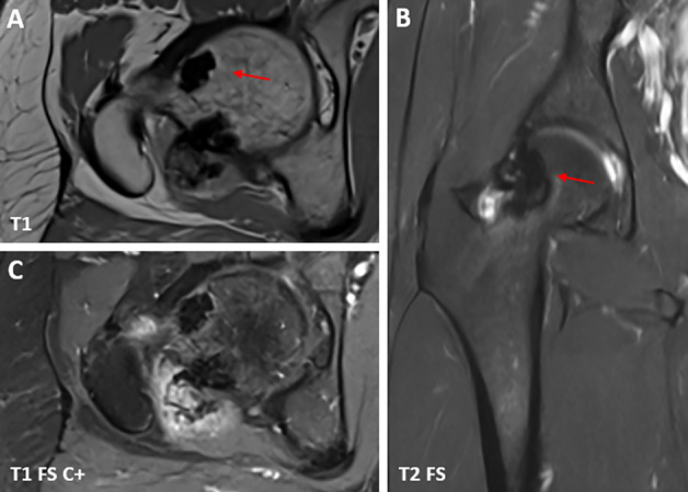 Melorheostosis Involving the Hip Joint.