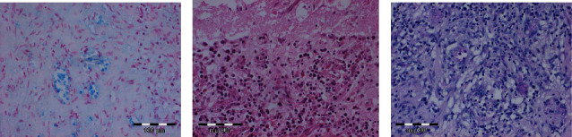 Late Relapse of Previous Pulmonary Cryptococcosis With Symptoms Resembling Cerebral Infarction: A Case Report.