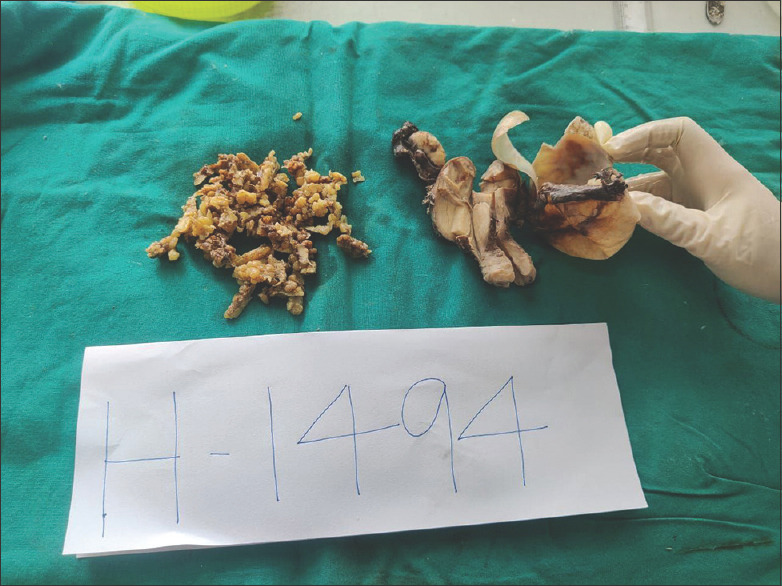 Primary Peritoneal Serous Carcinoma with Coexistent Mucinous Cystadenoma of Ovary - A Rare Case Report.