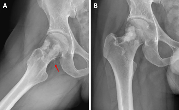 Melorheostosis Involving the Hip Joint.