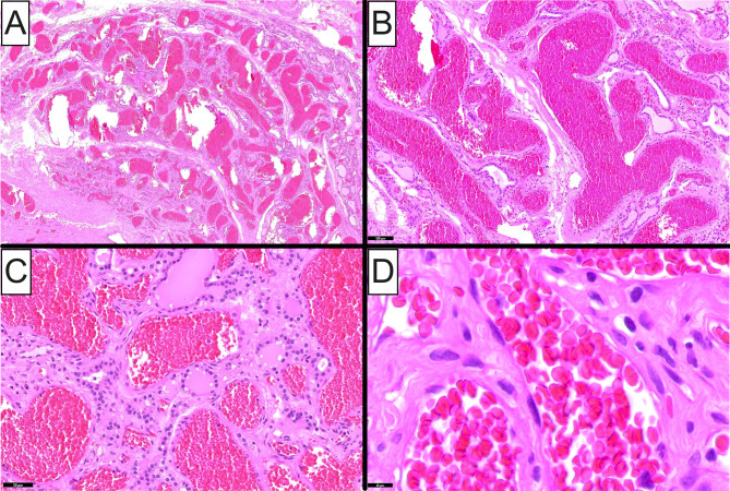 On Vascular Lesions of the Thyroid Gland with Emphasis on Intrathyroidal Hemangioma: Clinicopathologic Characterization of Two Cases and Review of the Literature.