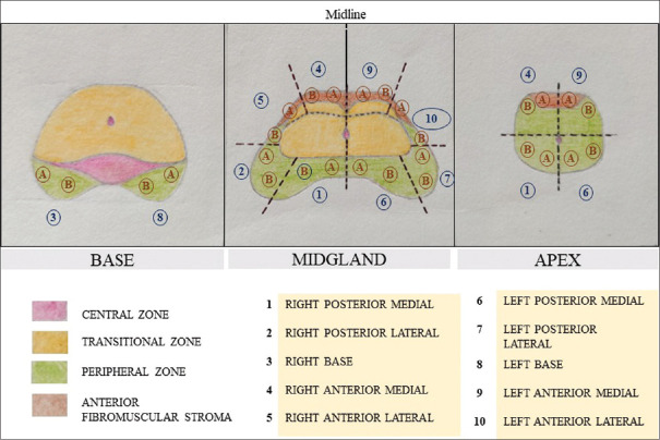 Factors influencing urinary retention following freehand transperineal prostate biopsy: Insights from a tertiary care center study.