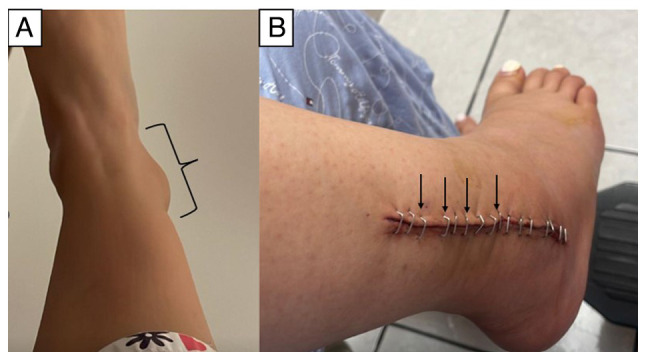 Successful treatment of osteosarcoma in a pregnant woman with survival of the gestational product: A case report and literature review.