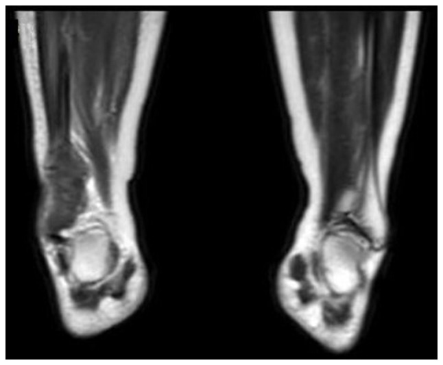 Successful treatment of osteosarcoma in a pregnant woman with survival of the gestational product: A case report and literature review.