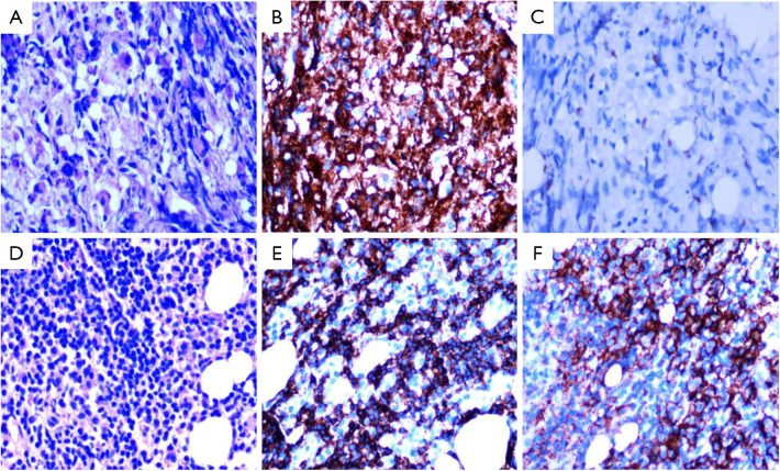 Prognostic impact of concordant and discordant bone marrow involvement on diffuse large B-cell lymphoma.
