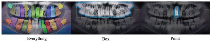 Deep Learning-Based Detection of Impacted Teeth on Panoramic Radiographs.