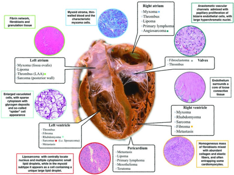 Approach to cardiac masses: Thinking inside and outside the box.